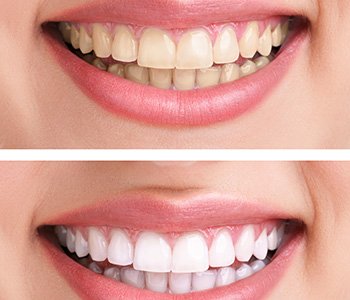 Dr. Clint Bruyere, Clint Bruyere, DDS The dental veneer procedure in Longview quickly and dramatically improves your smile