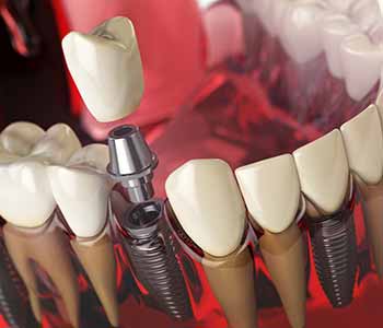 Dr. Clint Bruyere, Clint Bruyere, DDS Providing Highly respected dentist in Longview, TX highlights the benefits of dental implants
