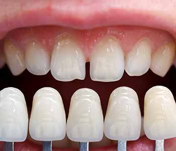 Dr. Clint Bruyere, Clint Bruyere, DDS Providing Patients seek Longview dentist for replacement of loose dentures