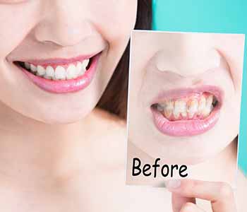 Transform your smile with a conservative porcelain veneer procedure. Call Dr. Cint Bruyere of Longview,