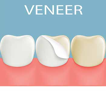 The first step is a consultation with Dr. Bruyere. He will perform an examination to ensure that you are a suitable candidate. Veneers are an excellent solution for most people with good oral health.