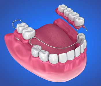 Partial dentures use a metal and acrylic framework to snap into place with the existing teeth.