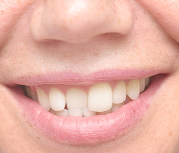 Cosmetic Dental Solutions for Crooked Teeth in Longview area