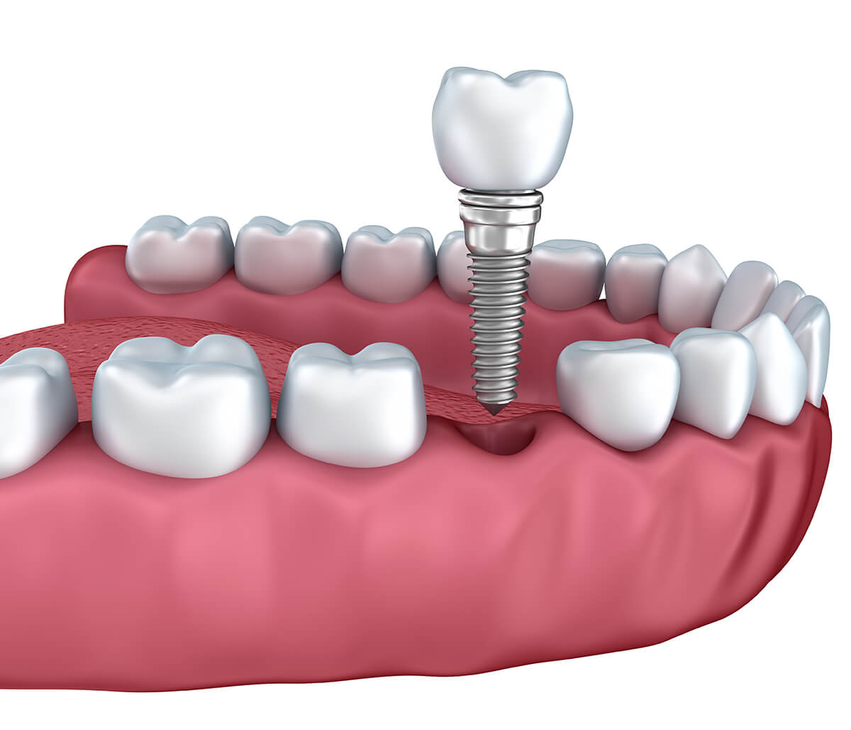 Dental Implants for Seniors in Longview TX Area
