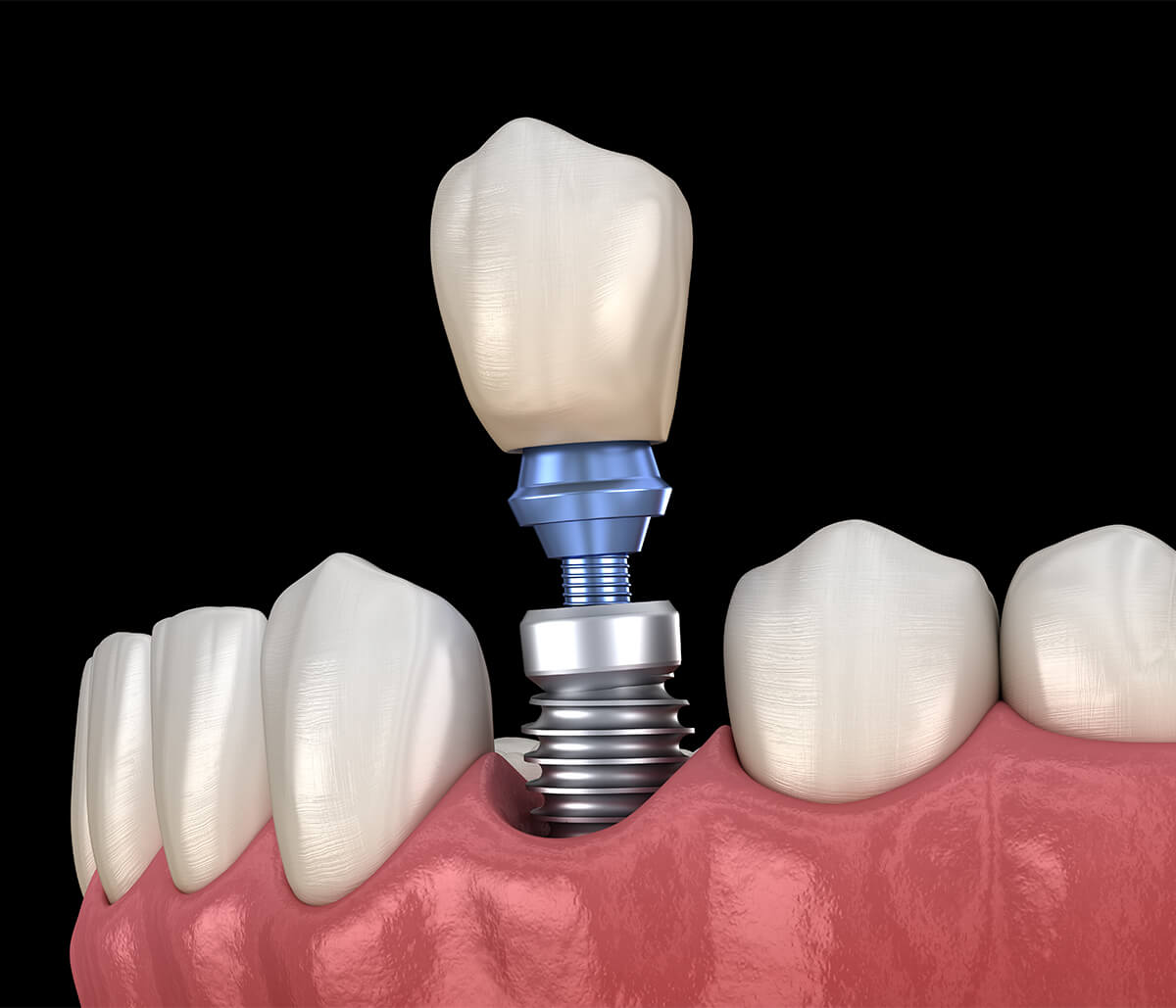 Dental Implant Services in Longview TX Area