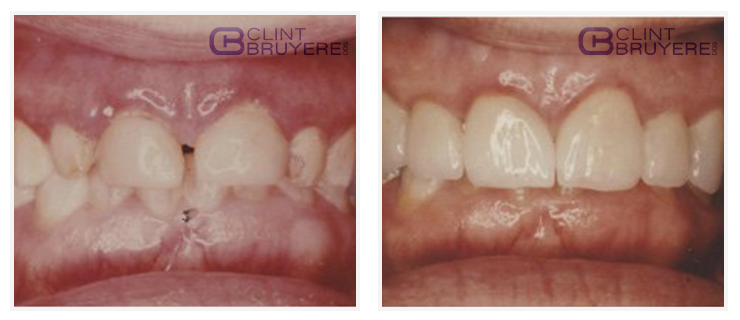 Before & After results of Porcelain Crowns best dental treatment 