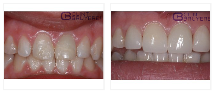 Best Dentist for results Dental Crowns and Bridges Before & After patients smile transformations 