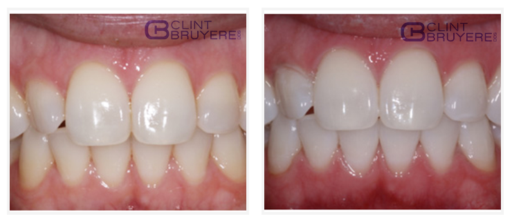 Teeth Whitening Before and After Patient Results in LongView TX 