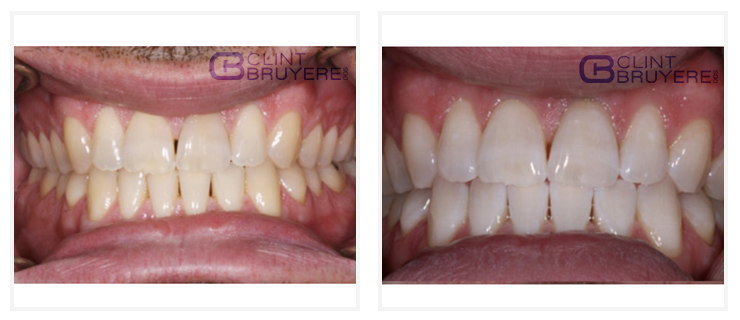Teeth Whitening Before and After Patient Results in LongView TX 