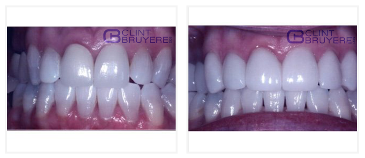 Longview TX Dental Crowns for Tooth restore 