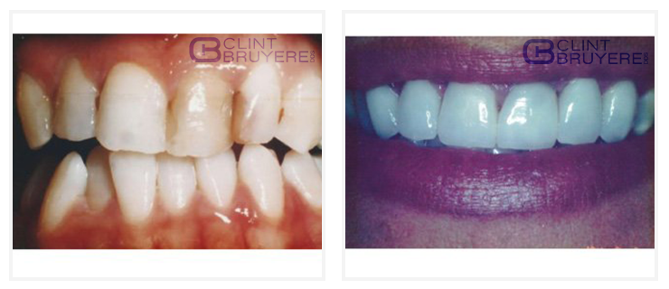 Dental Crowns Before & After patients smile transformations 