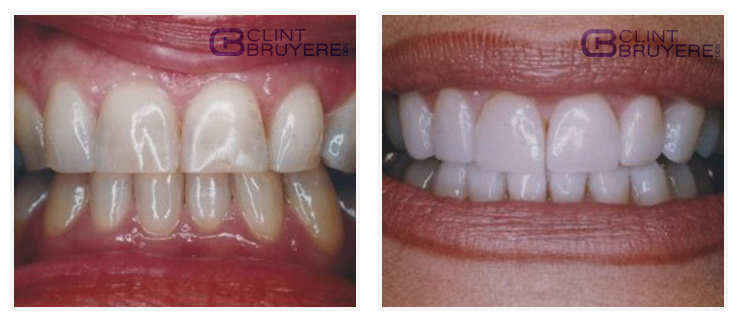 Porcelain veneers Before and after patient results in Longview TX 