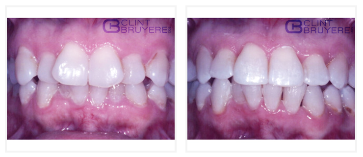 Six Month Smiles procedure done in the area Longview TX by best dentist 