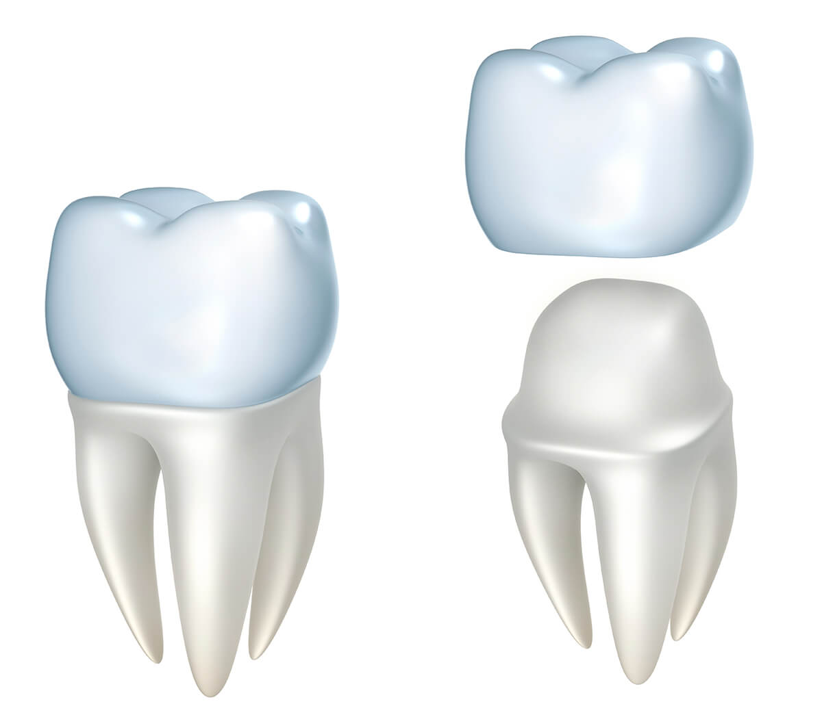 Dental Crown Replacement in Longview TX Area